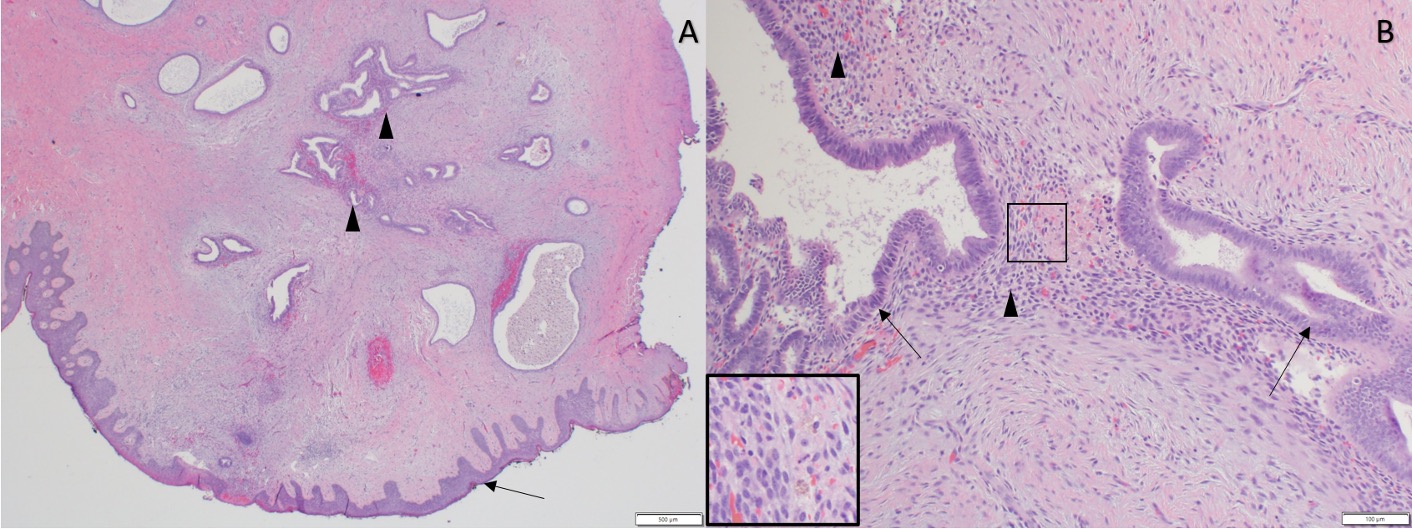 Abdominal wall endometrioma in the setting of prior vaginostomy tube