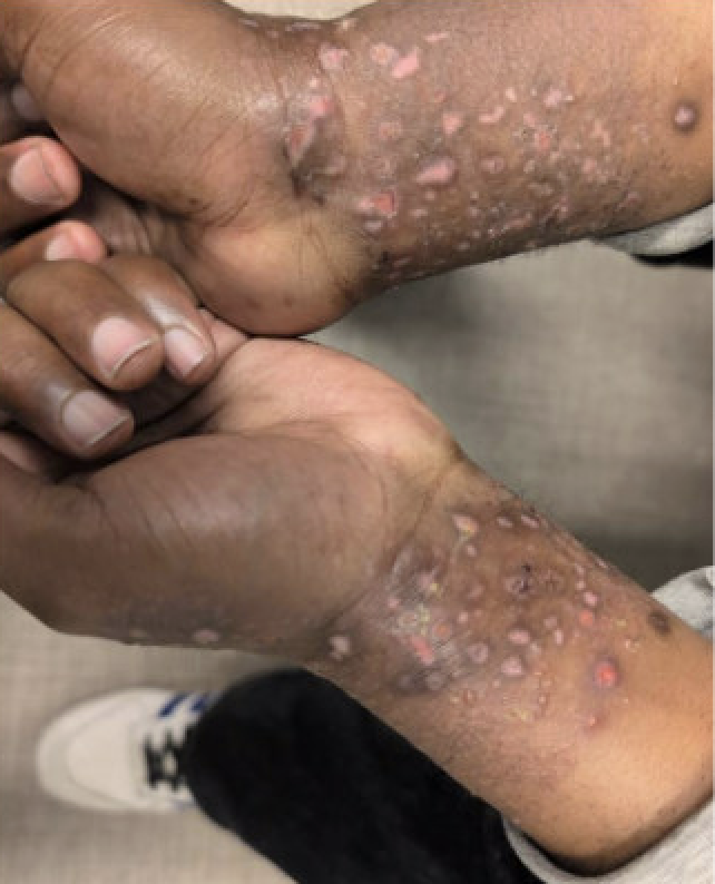 glp 1 eczema DRUG-INDUCED BULLOUS PEMPHIGOID TRIGGERED BY GLP-1 RECEPTOR AGONIST - SHM  Abstracts